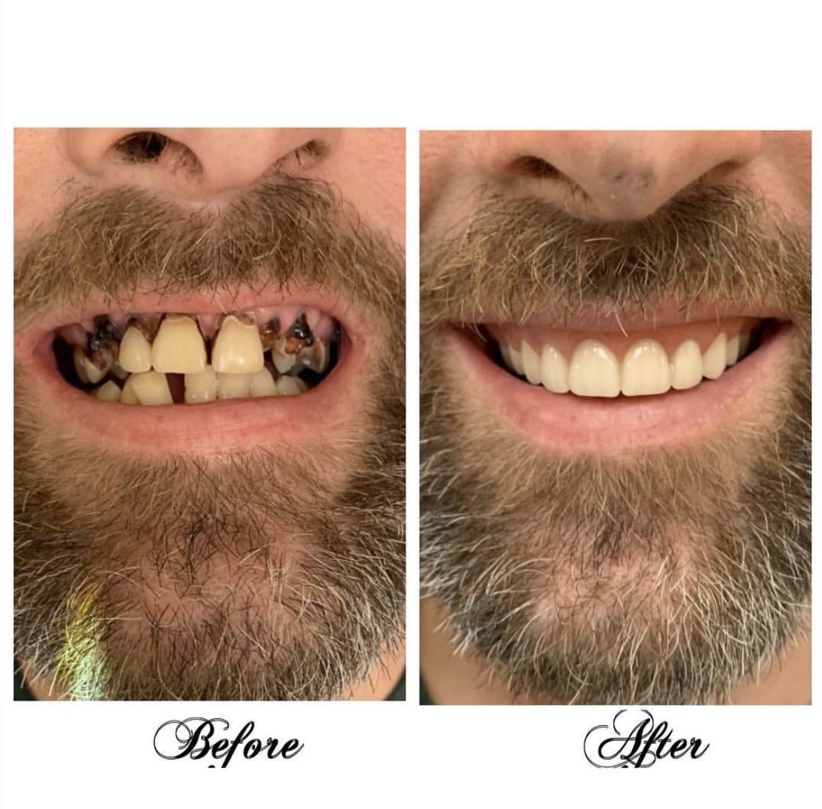 FL Implants For Less 